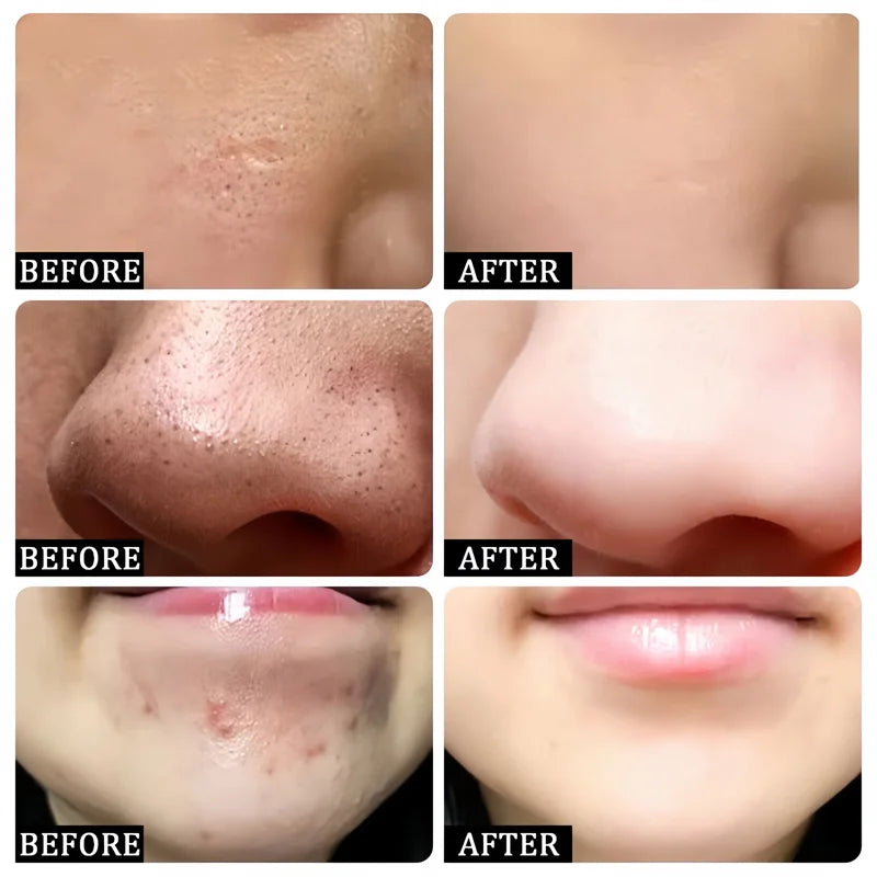 Pore Shrinking Cream Acne Pit Repair Product For Men Women Remove Acne Print Scar Large Pore Anti-Inflammatory Smooth Skin Cream