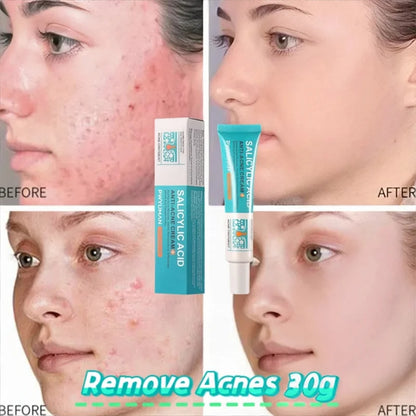 Pore Shrinking Cream Acne Pit Repair Product For Men Women Remove Acne Print Scar Large Pore Anti-Inflammatory Smooth Skin Cream